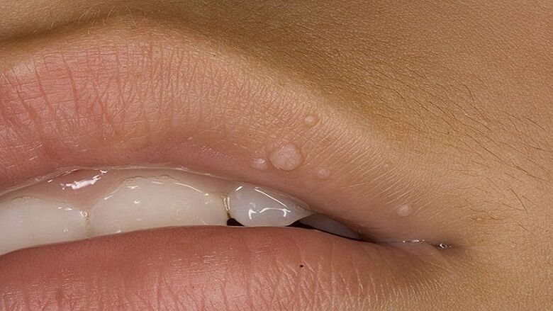 Papilloma στο χείλος