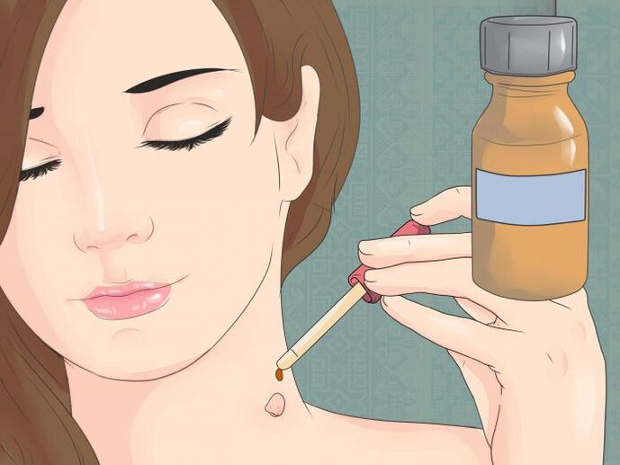 Χρησιμοποιήστε το φάρμακο με τη μορφή διαλύματος για την αφαίρεση των θηλωμάτων στο λαιμό
