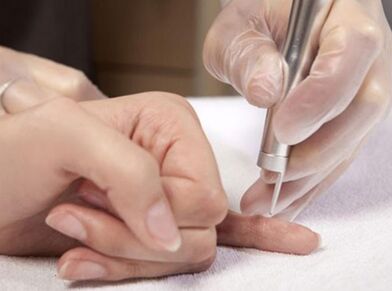 Διεξαγωγή θεραπείας με λέιζερ