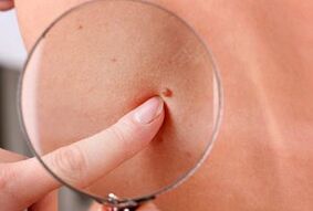 Λόγοι για την εμφάνιση θηλωμάτων στο ανθρώπινο σώμα