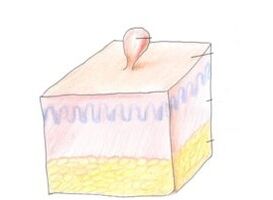 πώς να απαλλαγείτε από τα θηλώματα στο σώμα